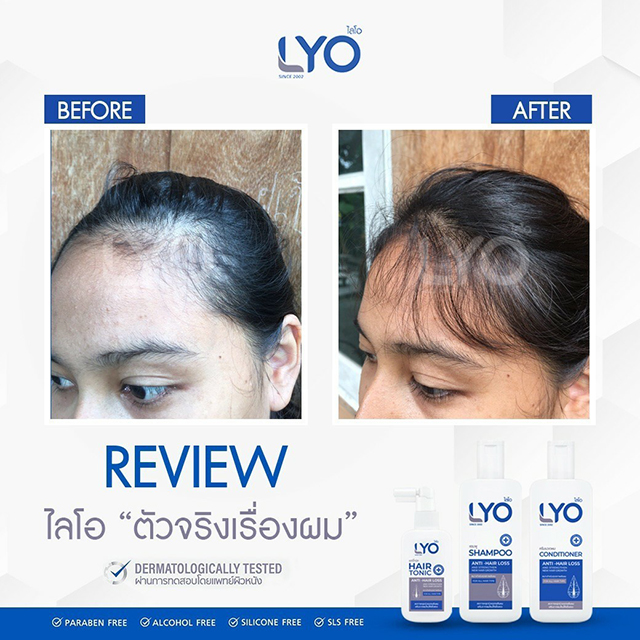 LYO ไลโอ ผลิตภัณฑ์ป้องกันผมร่วง หนุ่ม กรรชัย